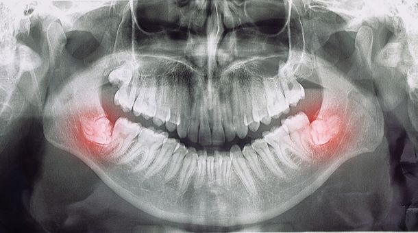 What are the Benefits of Wisdom Teeth?